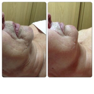 Före och Efter NBE DEEP SKIN Före och Efter NBE DEEP SKIN